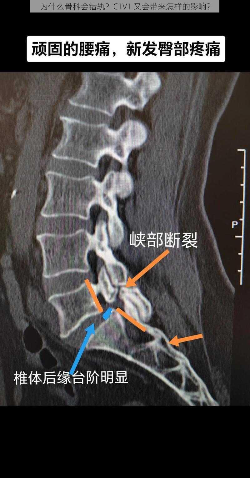 为什么骨科会错轨？C1V1 又会带来怎样的影响？